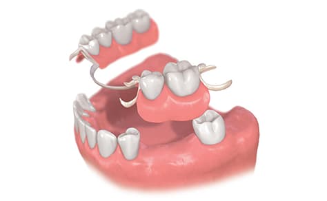 入れ歯・ブリッジなどの歯の欠損治療イメージ