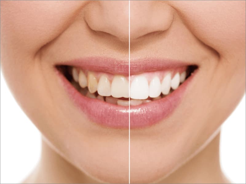 歯のホワイトニング治療イメージ写真