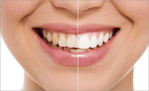 歯のホワイトニング治療イメージ写真